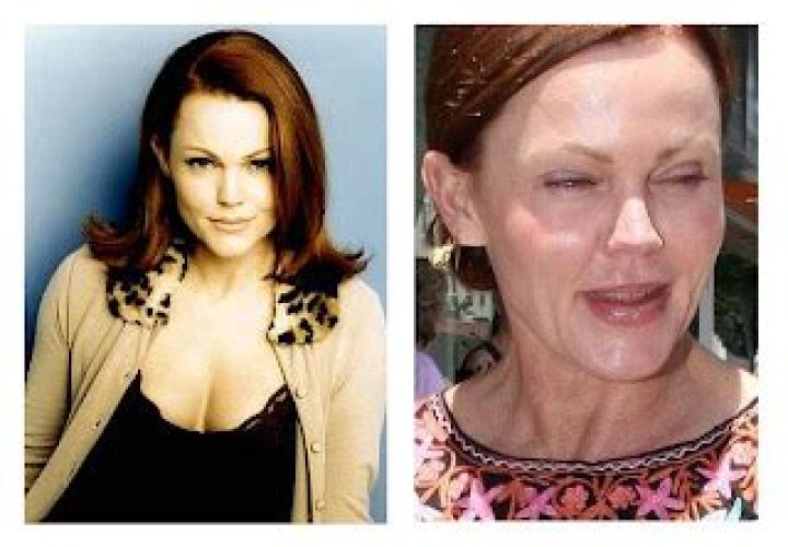 What Other Procedures Has She Undergone Other Than Botox?