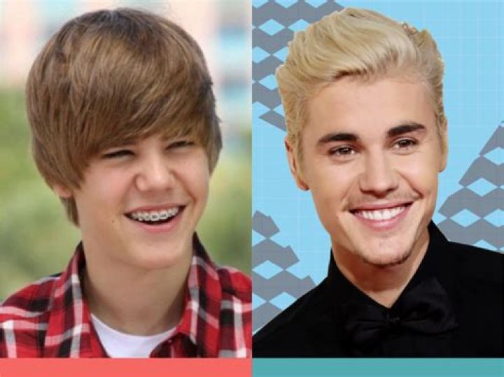 Has Justin Bieber Ever Had Braces?